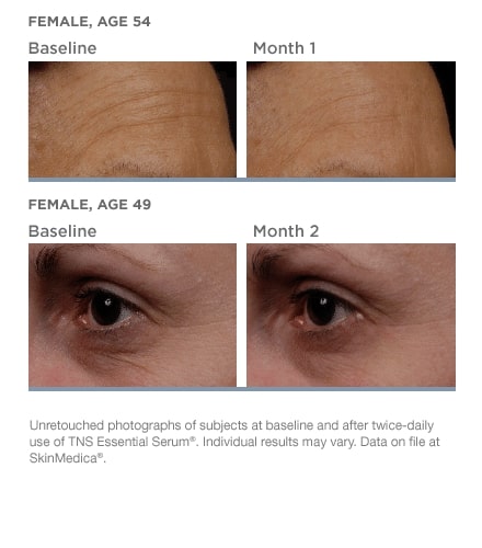 patient’s eyes and forehead before and after skinmedica essential serum, fewer wrinkles after treatment