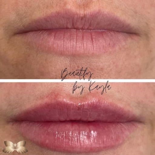 Lip Augmentation Before and Afer 1