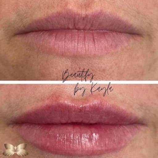 Lip Augmentation Before and Afer 1 Lip Augmentation Before and Afer 1