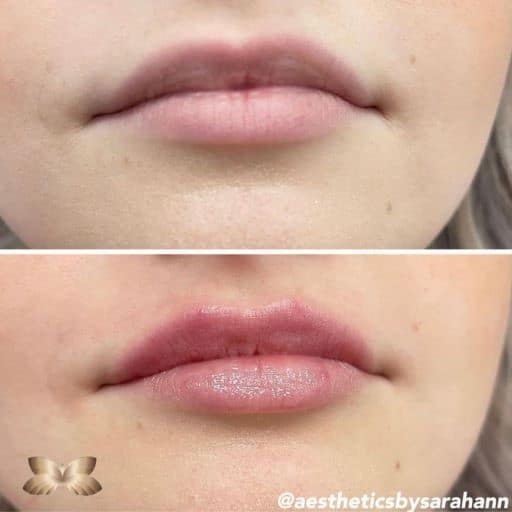 Lip Augmentation Before and Afer 2