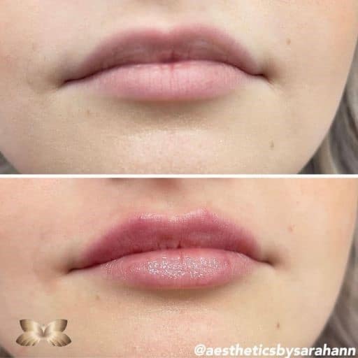 Lip Augmentation Before and Afer 2 Lip Augmentation Before and Afer 2