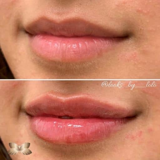 Lip Augmentation Before and Afer 3