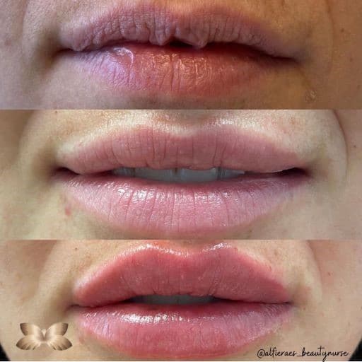 Lip Augmentation Before and Afer 4
