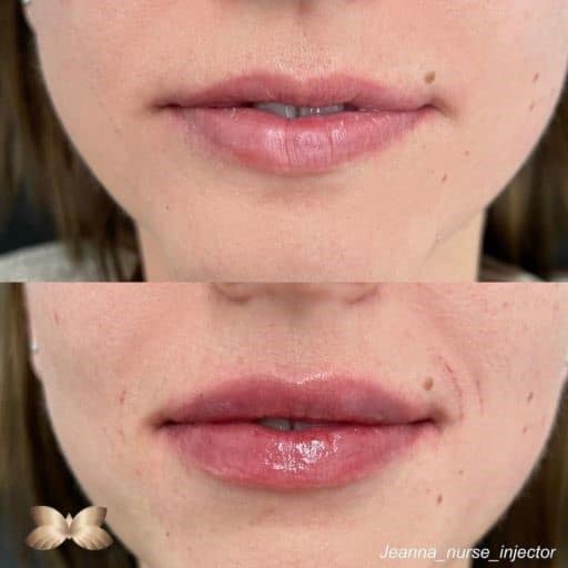 Lip Augmentation Before and Afer 5
