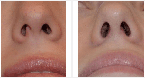 Septoplasty before and after