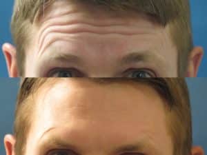 botox forehead wrinkles