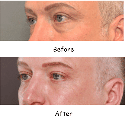 Eyelid lift Lower before and after 2