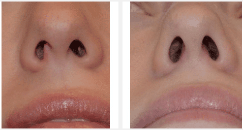 Septoplasty before and after Septoplasty before and after