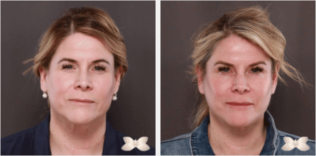 2022 05 03 10 00 13 Estiramiento facial y estiramiento de párpados por el Dr. Henstrom Caso 20851 Utah Facial Plastics - M