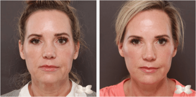 2022 05 03 10 06 21 Estiramiento facial por el Dr. Thompson Caso 19942 Utah Facial Plastics — Mozilla Firefox