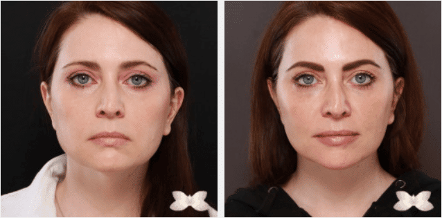 2022 05 03 10 11 37 MACSlift Por Dr. Henstrom Caso 20412 Utah Facial Plastics — Mozilla Firefox
