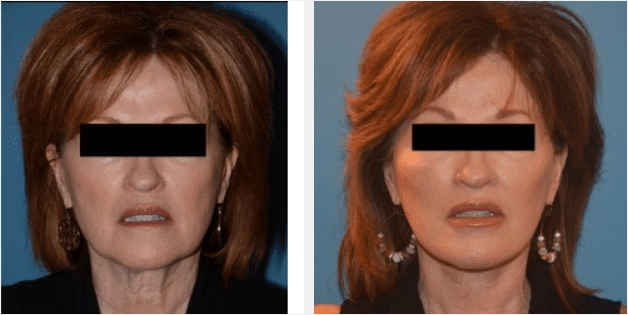 2022 05 03 10 12 51 Estiramiento facial por el Dr. Thompson Caso 12768 Utah Facial Plastics — Mozilla Firefox