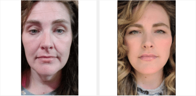 2022 05 03 10 14 57 Estiramiento facial por el Dr. Thompson Caso 19473 Utah Facial Plastics — Mozilla Firefox