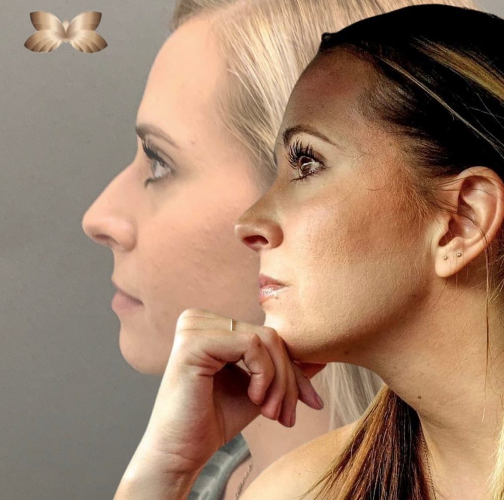 Everything you need to know about Rhinoplasty recovery