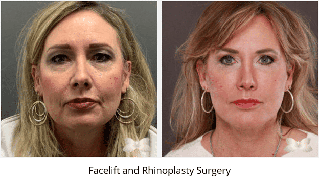 Facelift and Rhinoplasty Surgery