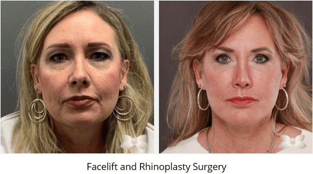 Cirugía de lifting facial y rinoplastia