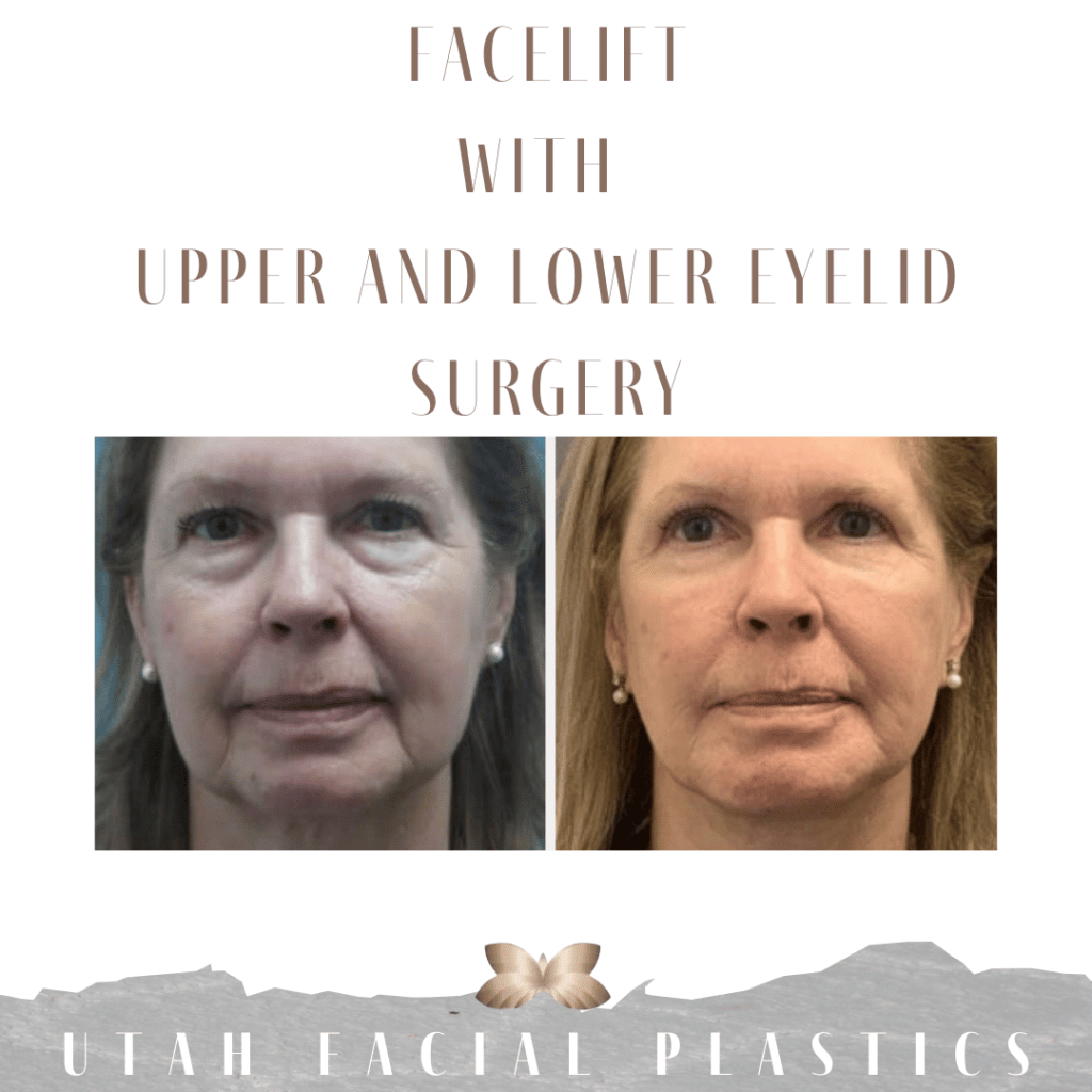 Facelift and eyelid surgery