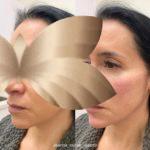 Filler Full Face Filler Full Face