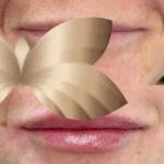 Filler Lips Filler Lips