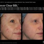Forever Clear acne treatment