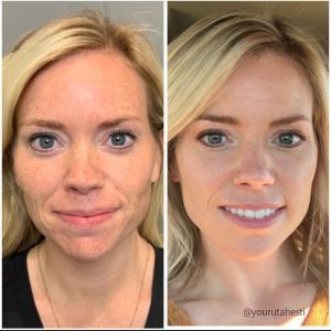 After 2 treatments After 2 treatments