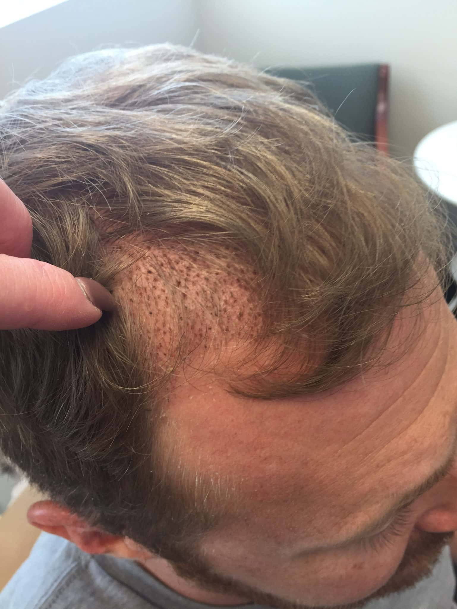 hair transplant surgery scabs