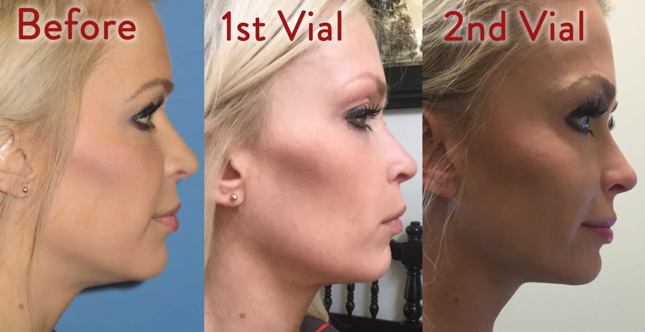 Kybella Is it worth it