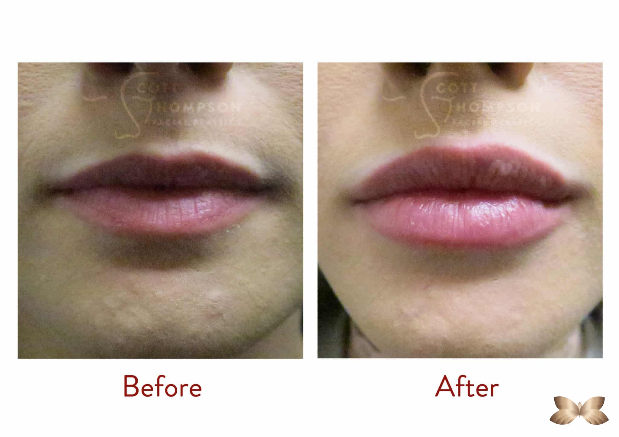 lip-augmentation