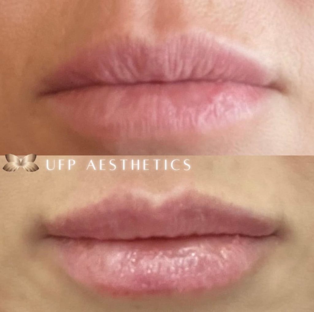 Lip Enhancement