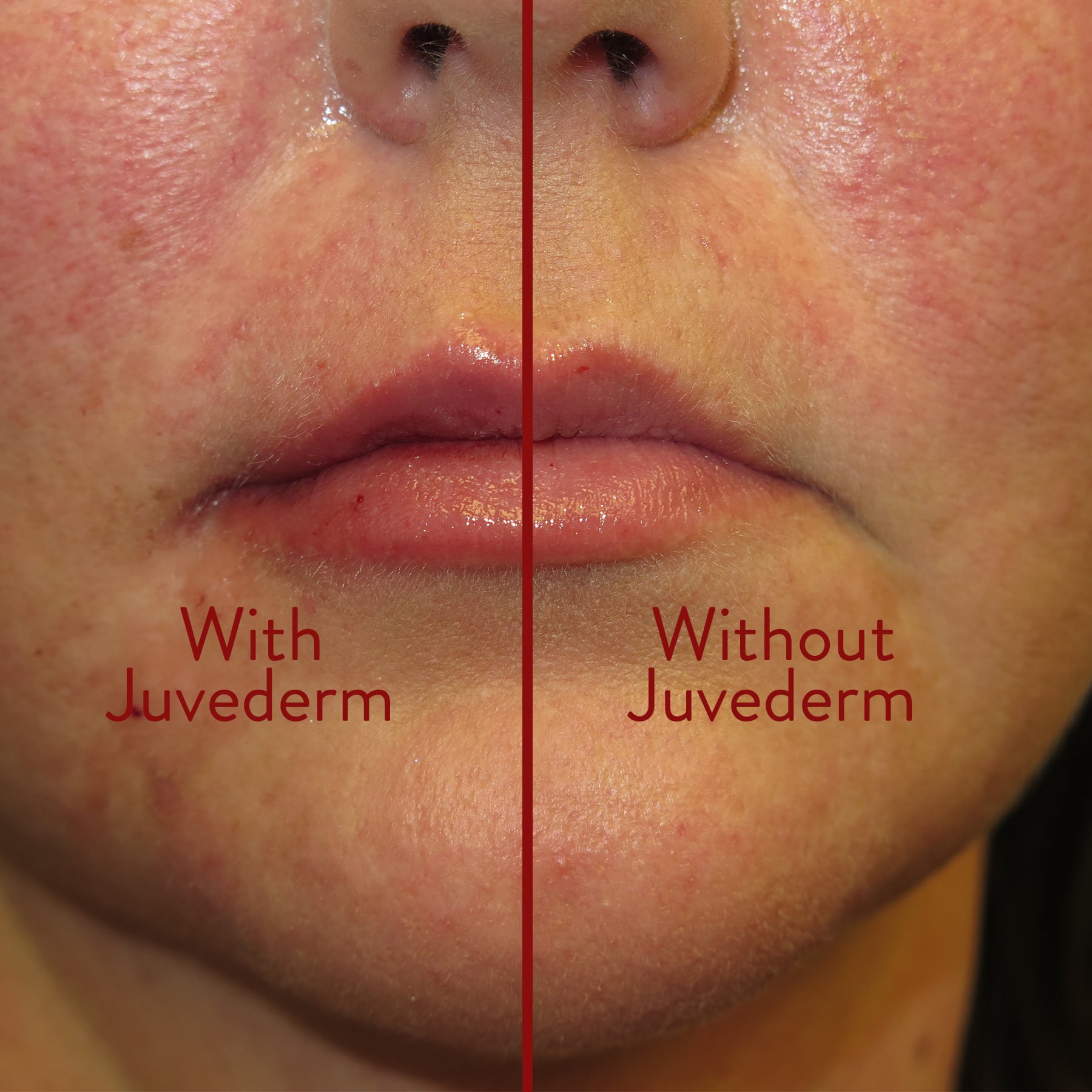 aumento de labios_Utah_Juvederm