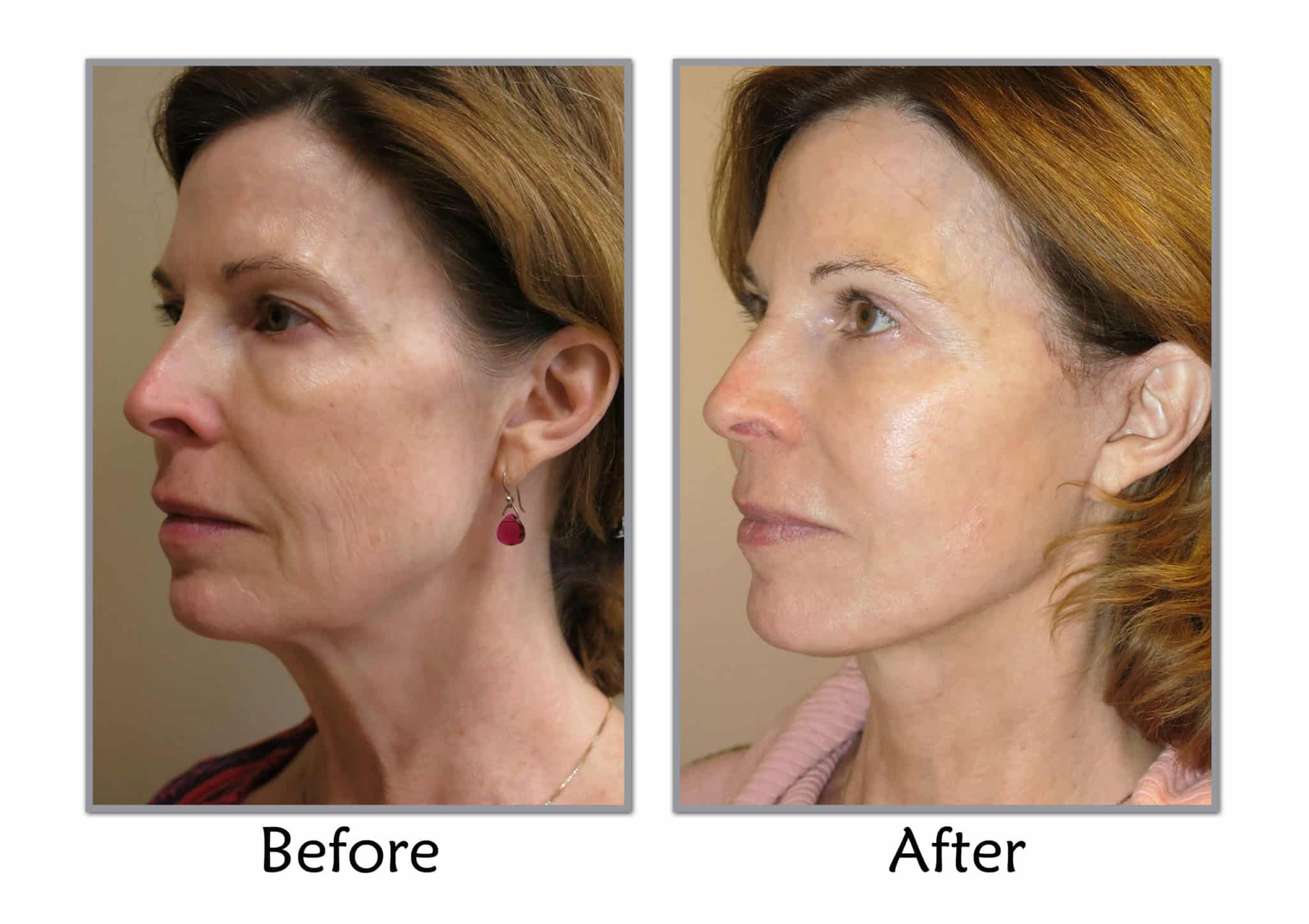 MACS facelift procedure