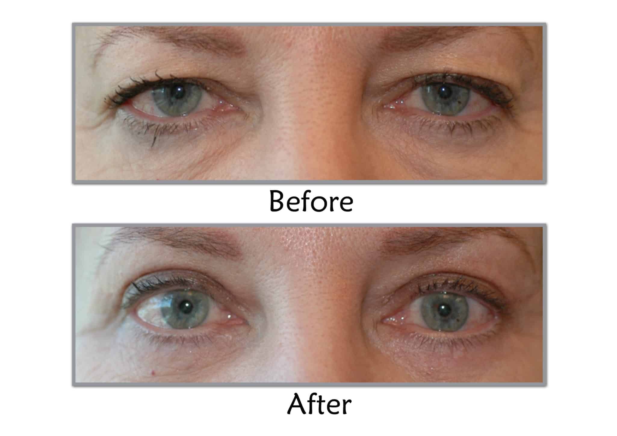 eyelid surgery results
