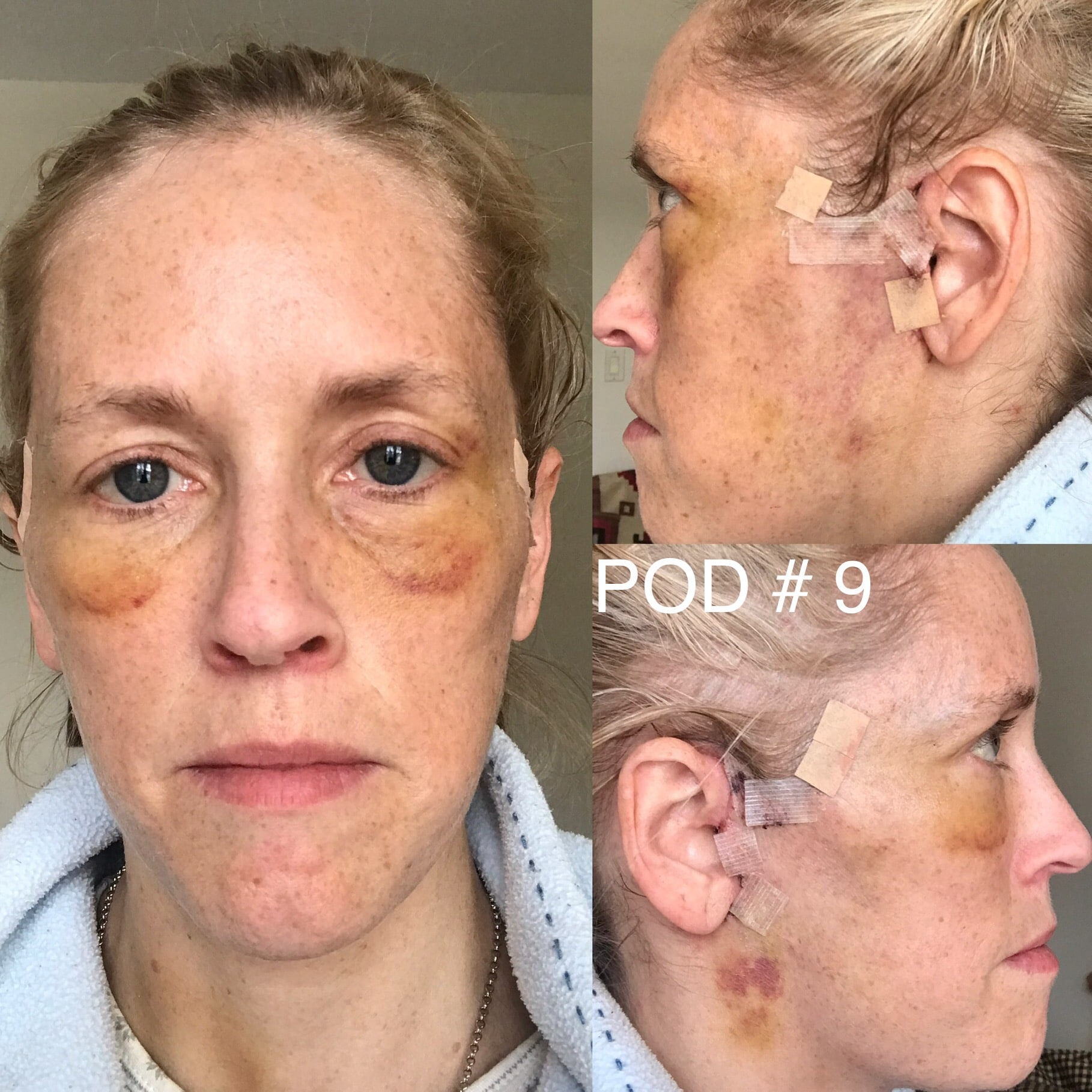 Who Fractured Ahna Macs Face 46 - rkantrz