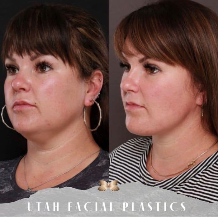 How Much Does A Facelift Usually Cost in Utah?