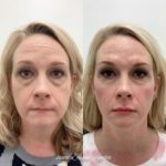 botox and filler before and after 