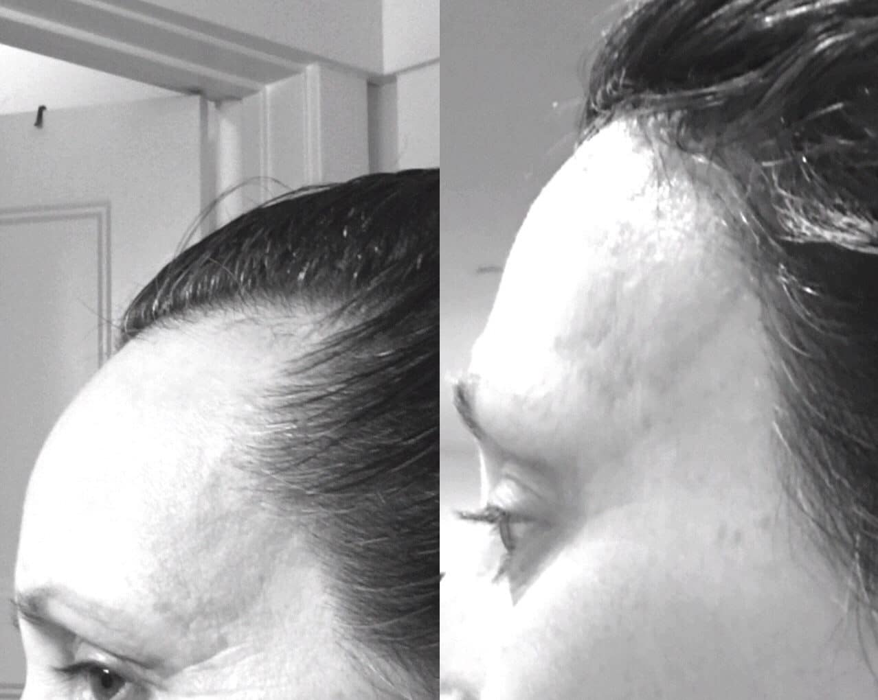 forehead-reduction-surgery