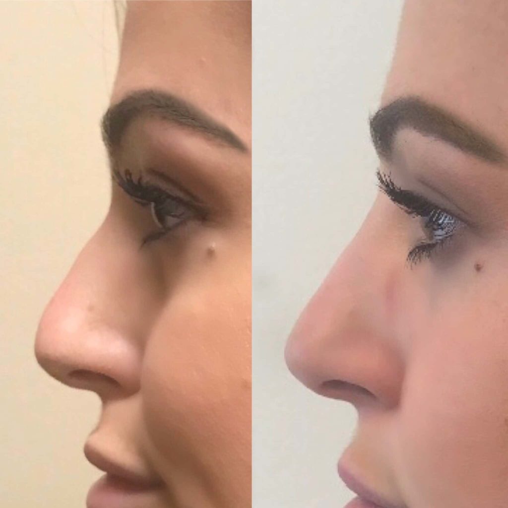 non-surgical nosejob