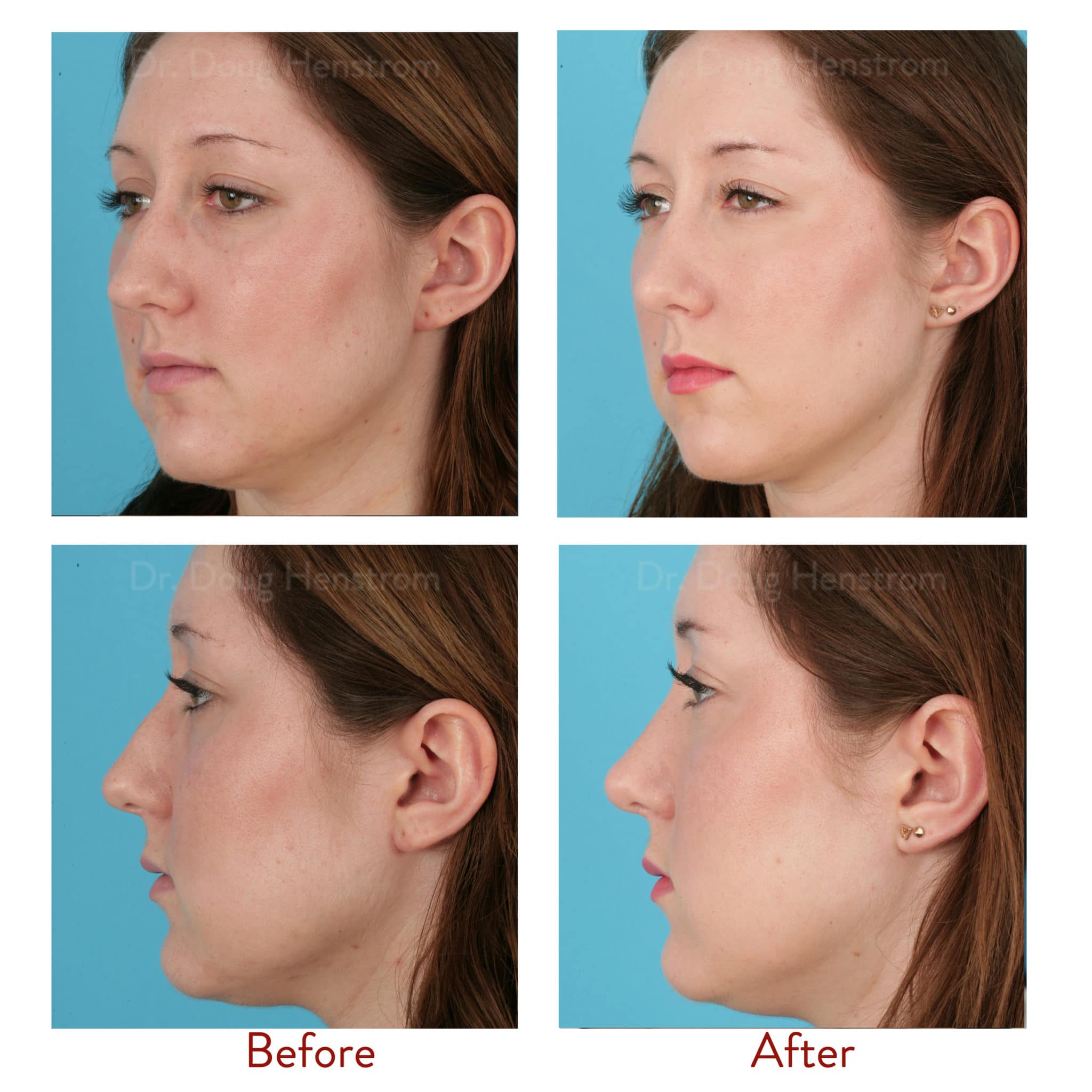 What is Cosmetic Surgery of the Nose?