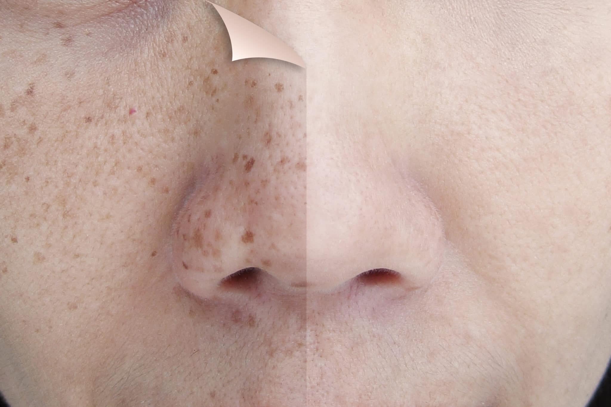 Hvis Portal boks What Is The Cost for Laser Skin Resurfacing? - Utah Facial Plastics