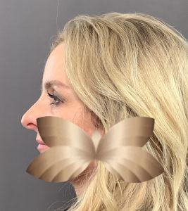 Before Image: Rhinoplasty by: Dr. Henstrom