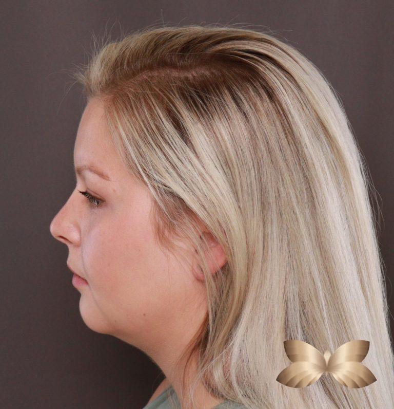 After Image: Submental Liposuction by: Dr. Thompson - left-side