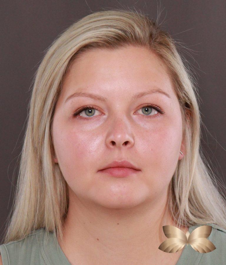 After Image: Submental Liposuction by: Dr. Thompson - front
