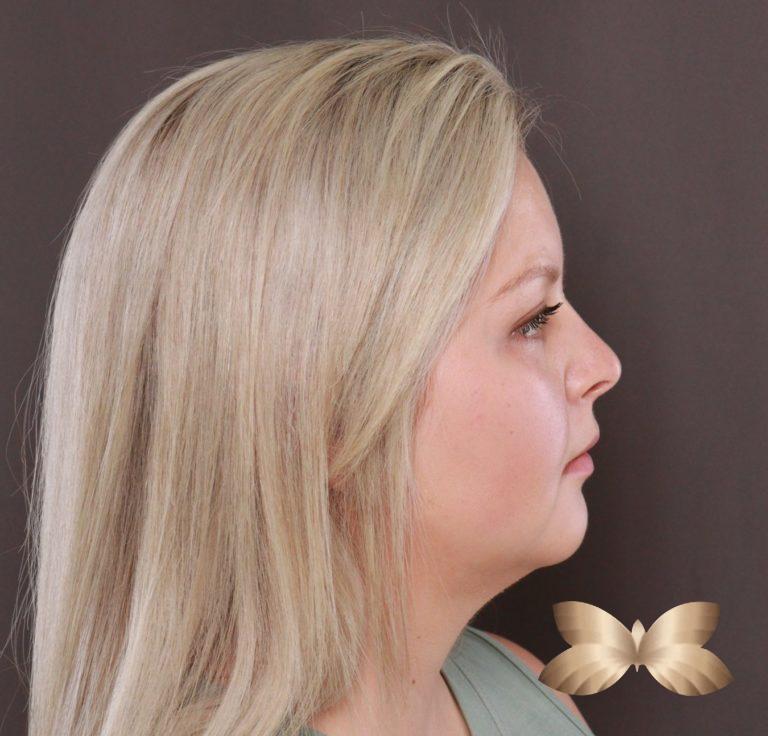 After Image: Submental Liposuction by: Dr. Thompson - right-side