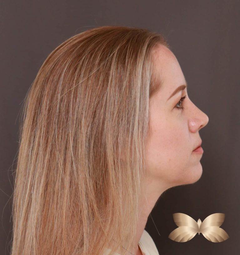 After Image: Rhinoplasty by: Dr. Henstrom - right-side