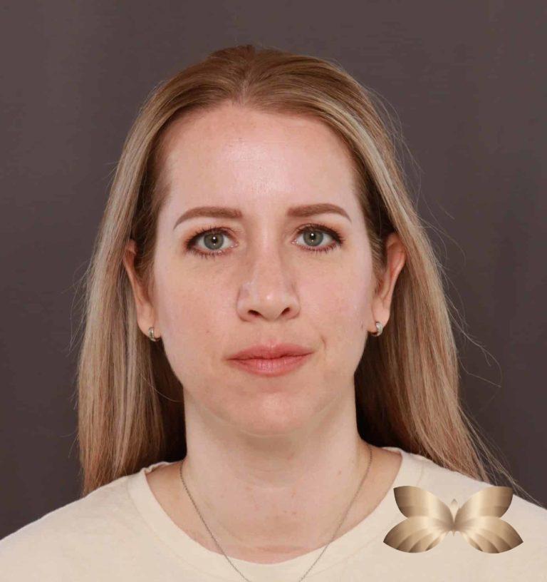 After Image: Rhinoplasty by: Dr. Henstrom - front