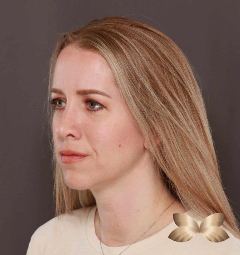 After Image: Rhinoplasty by: Dr. Henstrom - left-front-oblique