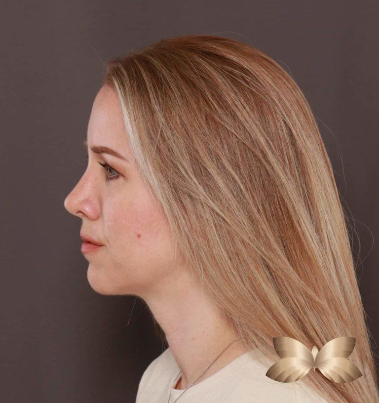 After Image: Rhinoplasty by: Dr. Henstrom - left-side