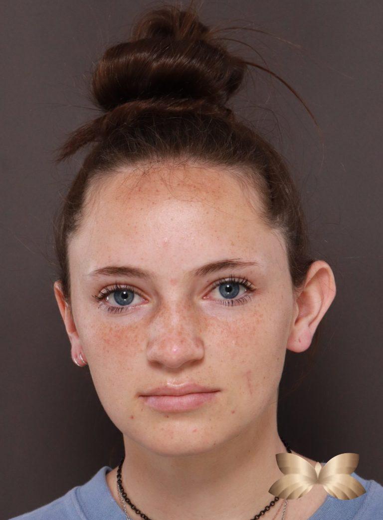Before Image: Otoplasty by: Dr. Thompson - front
