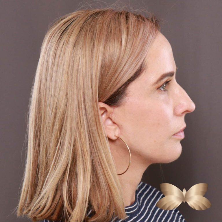 After Image: Facelift and Upper Eyelid Lift by: Dr. Thompson - right-side