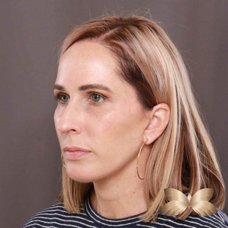 After Image: Facelift and Upper Eyelid Lift by: Dr. Thompson - left-front-oblique